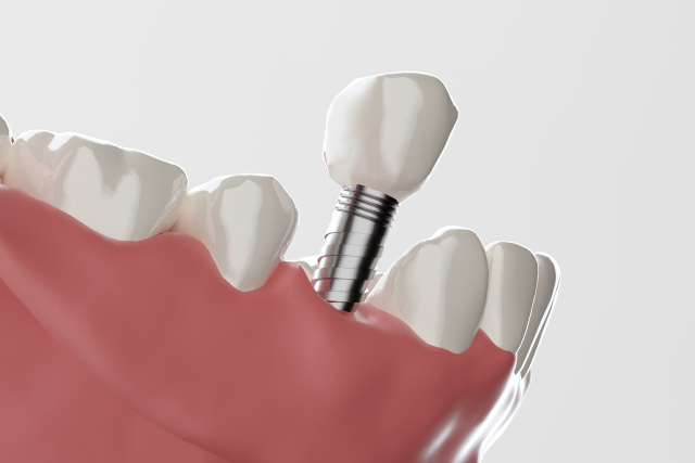 歯科医院での定期健診