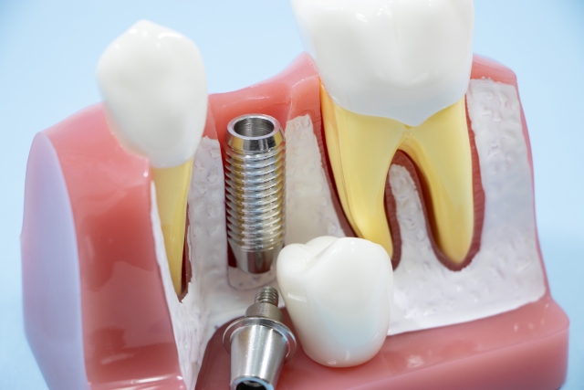 インプラントの上部構造が外れた場合